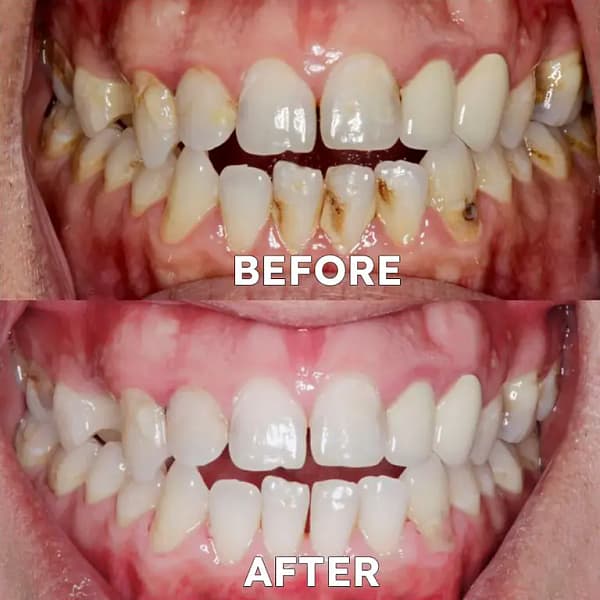Ourlyard® Tooth Health Mineral Powder