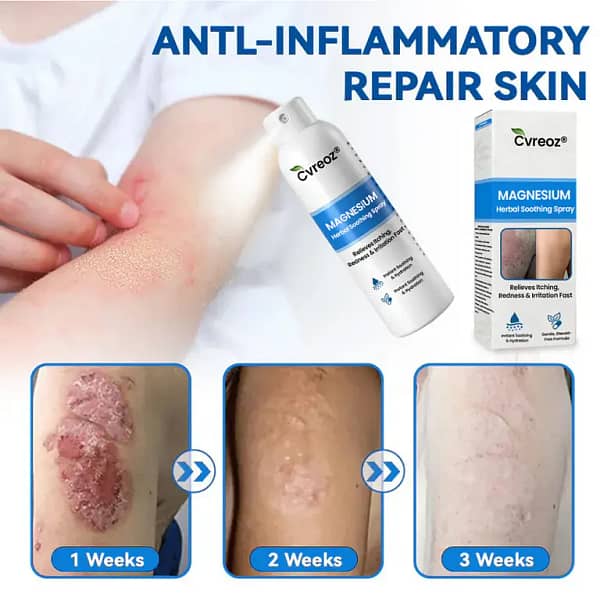 Cvreoz® Magnesium Herbal Psoriasis Spray