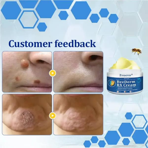 Zvoevo® BeeDerm RX Cream, Painless, Targeted Treatment for Warts