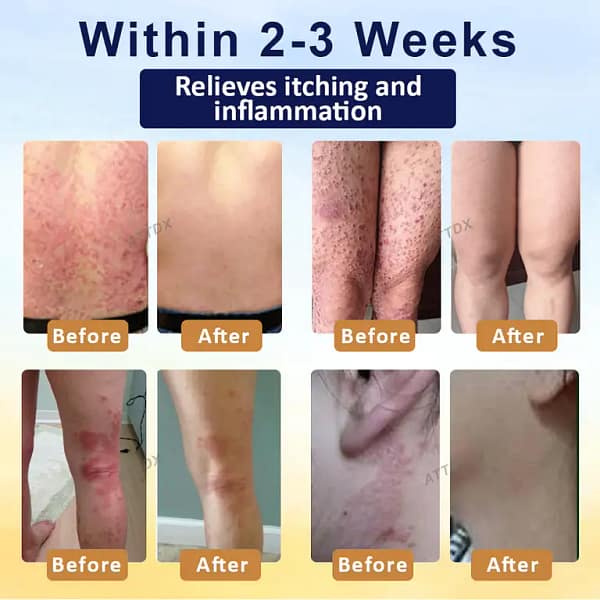 LOVILDS™ Psoriasis Care Mellifera Venom Skin Healing Spray