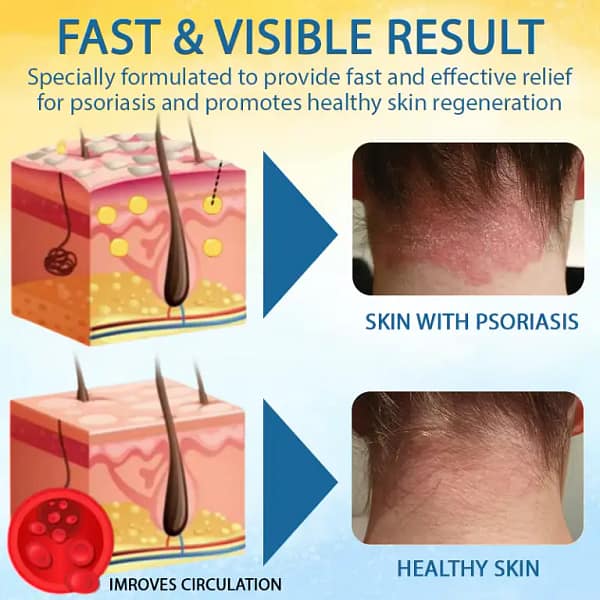 LOVILDS™ Psoriasis Care Mellifera Venom Skin Healing Spray