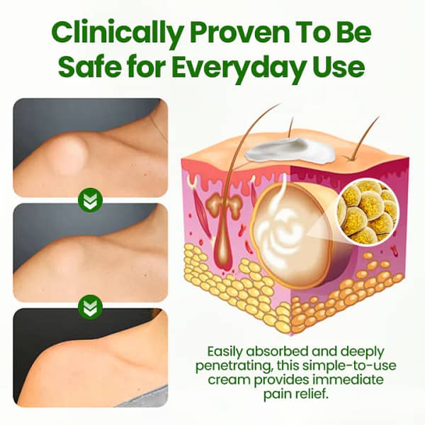 Biancat® KnotAway Lipoma Removal Cream