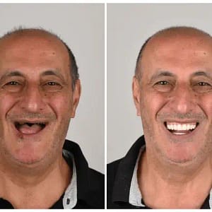 NESLEMY™ Custom-Fit Functional Dentures