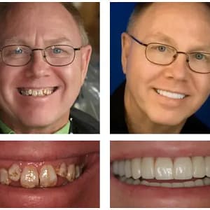 NESLEMY™ Custom-Fit Functional Dentures