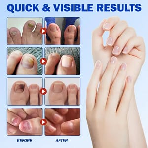 ClearNail | Combate el hongo. Fortalece tus uñas.