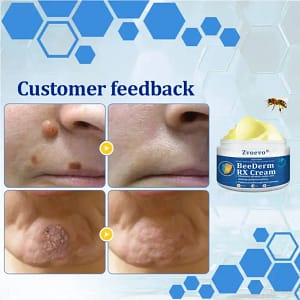 Zvoevo® BeeDerm RX Cream, Painless, Targeted Treatment for Warts