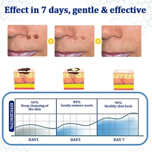Zvoevo® BeeDerm RX Cream, Painless, Targeted Treatment for Warts
