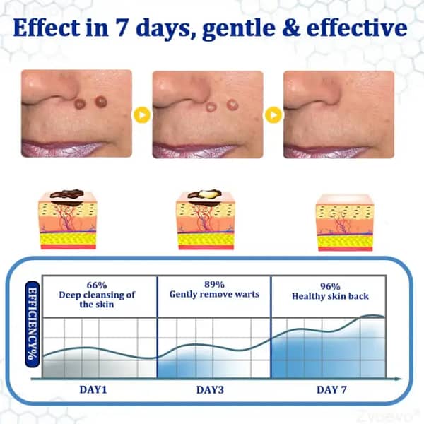 Zvoevo® BeeDerm RX Cream, Painless, Targeted Treatment for Warts