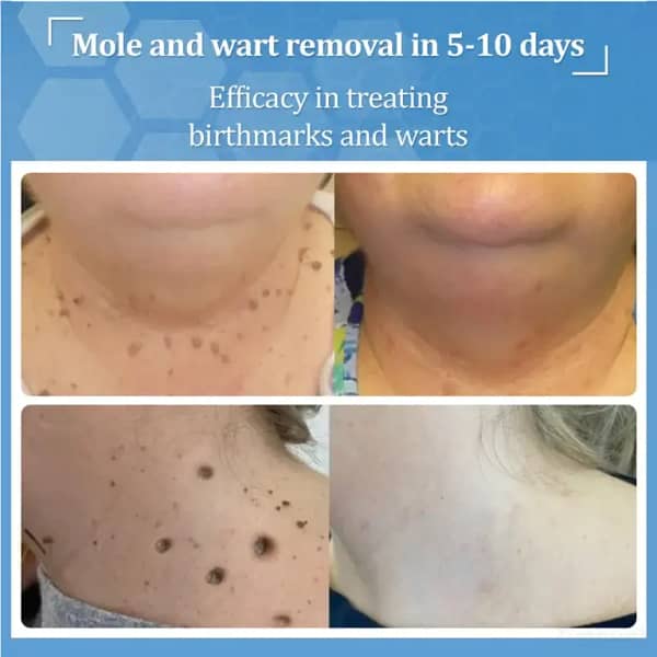 Zvoevo® BeeDerm RX Cream, Painless, Targeted Treatment for Warts