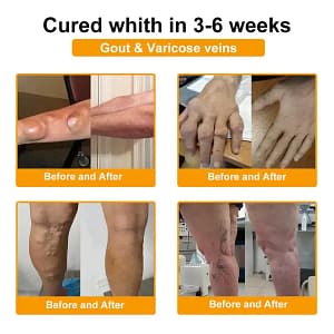 ODALIT™ Botulinum Toxin & Bee Venom Pain-Relief Bone Healing Cream