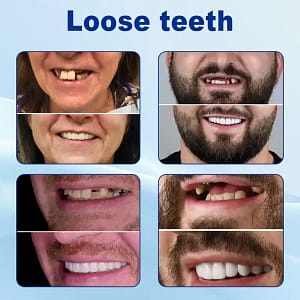 Nurbini™ Advanced Customized Full Denture Set