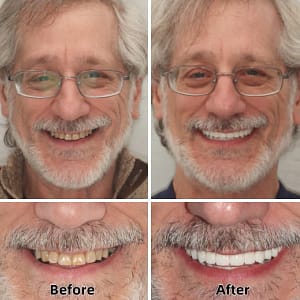 SmileFitPro™-Advanced Custom-Fit Functional Dentures