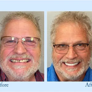 NESLEMY™ Custom-Fit Functional Dentures