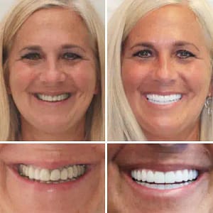 NESLEMY™Advanced Customized Full Denture SetNESLEMY™Advanced Customized Full Denture Set