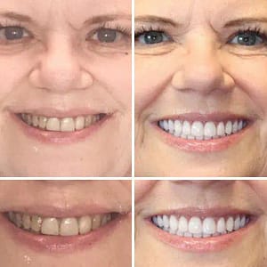 NESLEMY™Advanced Customized Full Denture Set