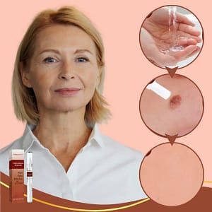 DermaLift™ Pen | Verwijdert wratten en ouderdomsvlekken