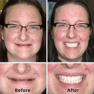 Tenowsy™-Advanced Custom-Fit Functional Dentures