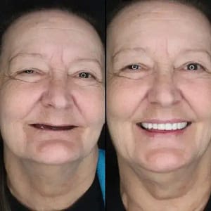 BQYOOM™-Custom-Fit Functional Dentures — Combination pack