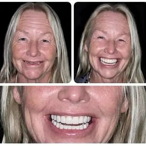 BQYOOM™-Custom-Fit Functional Dentures — Combination pack