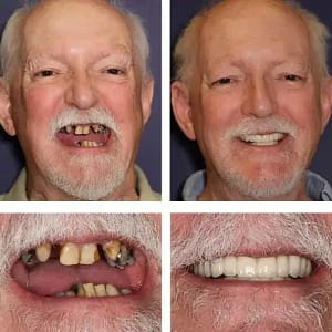 BQYOOM™-Custom-Fit Functional Dentures — Combination pack