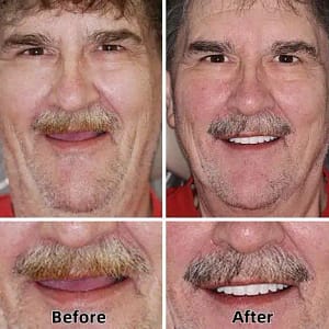 ROSOPL™-Advanced Custom-Fit Functional Dentures