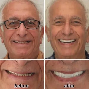 ROLOPL™ Custom Functional Denture Kits