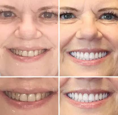 NESLEMY™Advanced Customized Full Denture Set