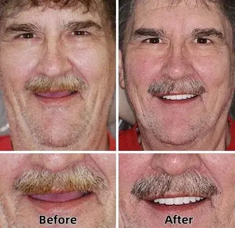BQYOOM™-Custom-Fit Functional Dentures — Combination pack