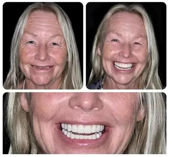 BQYOOM™-Custom-Fit Functional Dentures — Combination pack