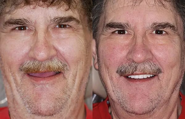 NESLEMY™Advanced Customized Full Denture Set