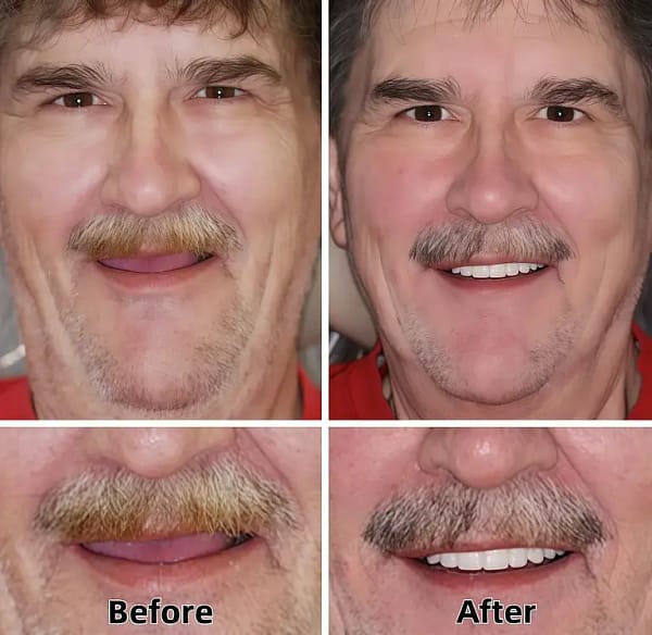 ROLOPL™ Custom Functional Denture Kits
