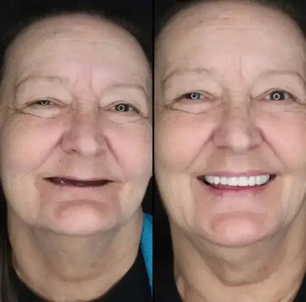 BQYOOM™-Custom-Fit Functional Dentures — Combination pack