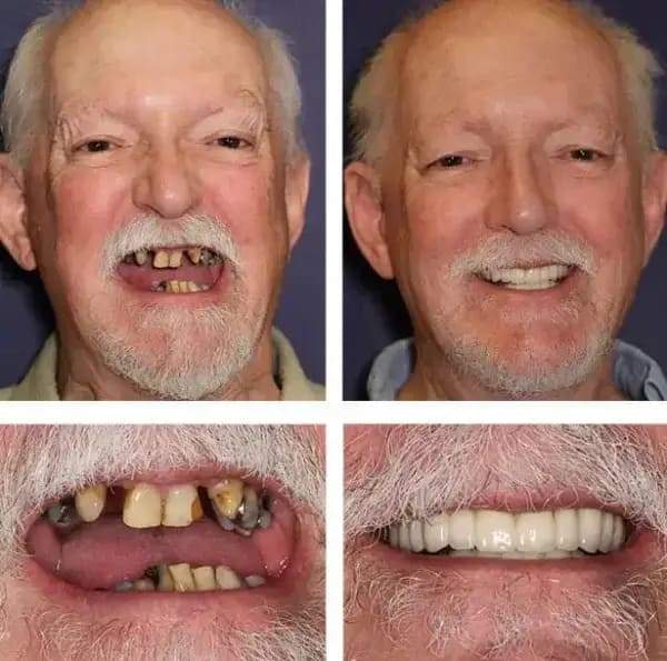 BQYOOM™-Custom-Fit Functional Dentures — Combination pack