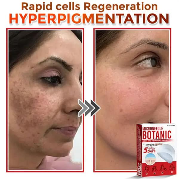 LOVILDS® MicroNeedle Botanic Skin Tag Removal Patch