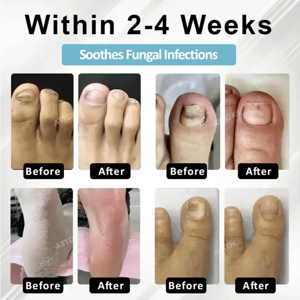 ATTDX® MycoStop Nail Recovery Serum Pen