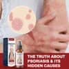 ATTDX® DermSoothe Psoriasis Relief Spray
