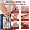 ATTDX® DermSoothe Psoriasis Relief Spray