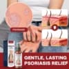 ATTDX® DermSoothe Psoriasis Relief Spray