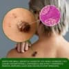LOVILDS™Tea Tree Focused Wart Away MicroDart Patch