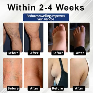 Fivfivgo® VenoHerb Black Cumin Edema Relief Balm