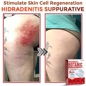 GFOUK MicroNeedle Botanic Skin Tag Removal PatchArtboard 18 8
