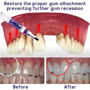 LOVILDS™ Gum Care Gel – Restore & Strengthen Your Gums