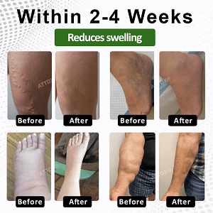 ATTDX® SwellSoothe Lymphatic Cream