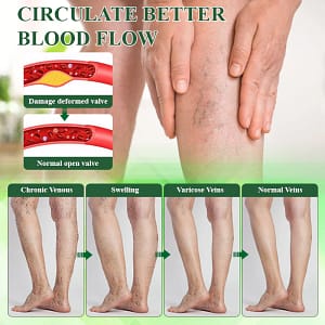 Oveallgo® VeinoRoll Therapy Edema Comfort Cream