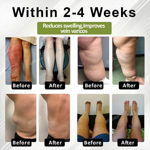 Oveallgo® VeinoRoll Therapy Edema Comfort Cream