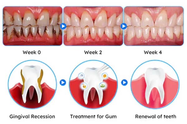 LOVILDS™ Gum Care Gel – Restore & Strengthen Your Gums