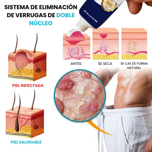 Cvreoz® removes genital warts from the root and without leaving a trace