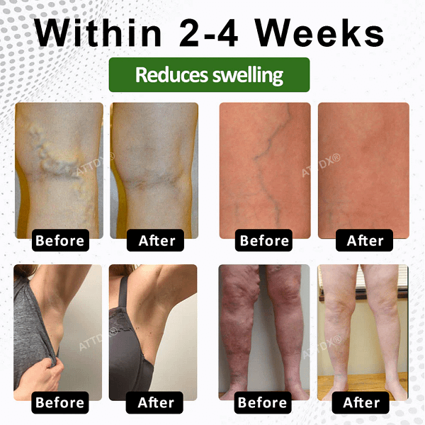 ATTDX® SwellSoothe Lymphatic Cream