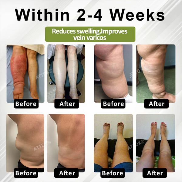 Oveallgo® VeinoRoll Therapy Edema Comfort Cream