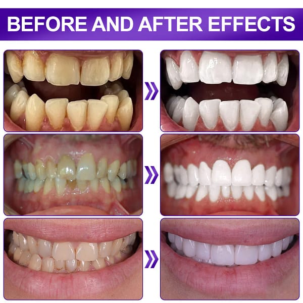 Flysmus® V34 Whitening Strips